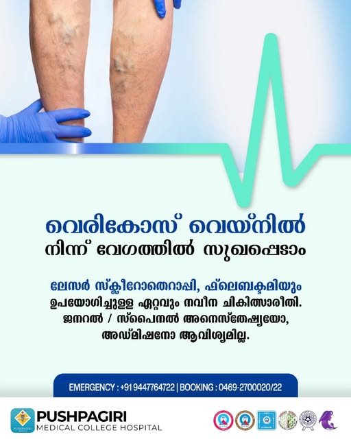 Varicose Veins Treatment